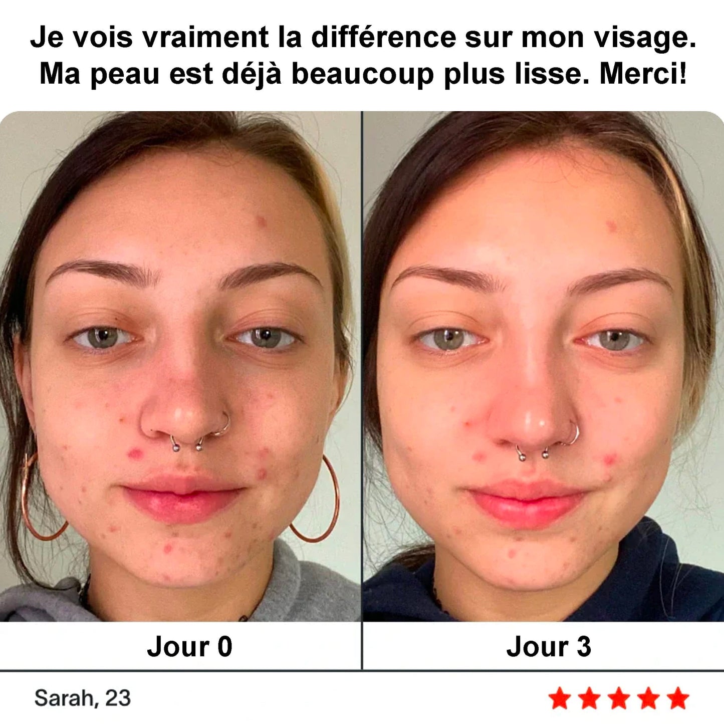 Stylo anti - acné à lumière bleue - Launchify